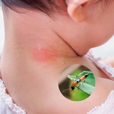 หมอเตือนภัย! 'แมลงก้นกระดก' วายร้ายที่ลูกน้อยต้องระวัง