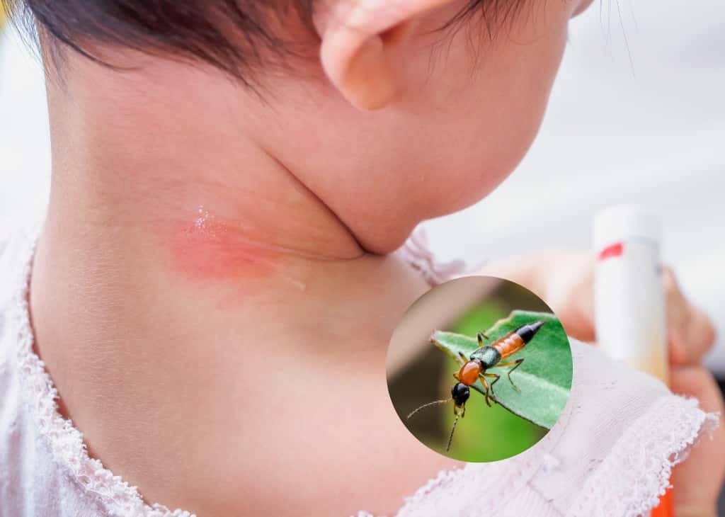 หมอเตือนภัย! 'แมลงก้นกระดก' วายร้ายที่ลูกน้อยต้องระวัง