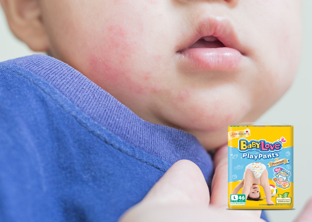 Baby Rash: Parents’ Trouble Everyday