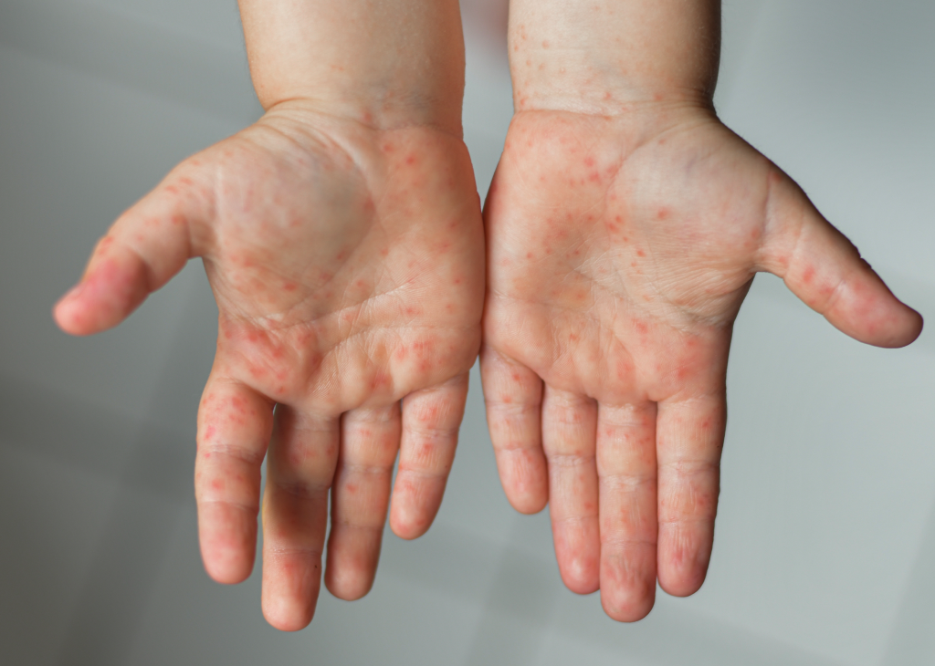 Children with high fever and red rashes should be watched carefully for risk of ‘scarlet fever’
