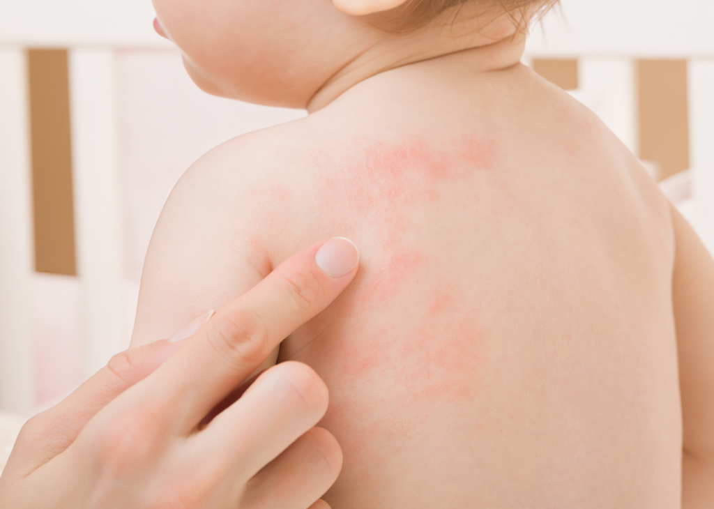 Dealing with 'Hives' in Children during Summer