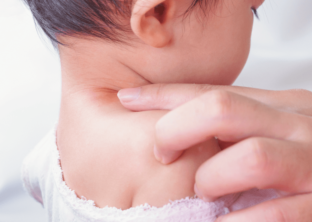 “Skin rash”: close danger that hurts baby's skin in hot and humid time