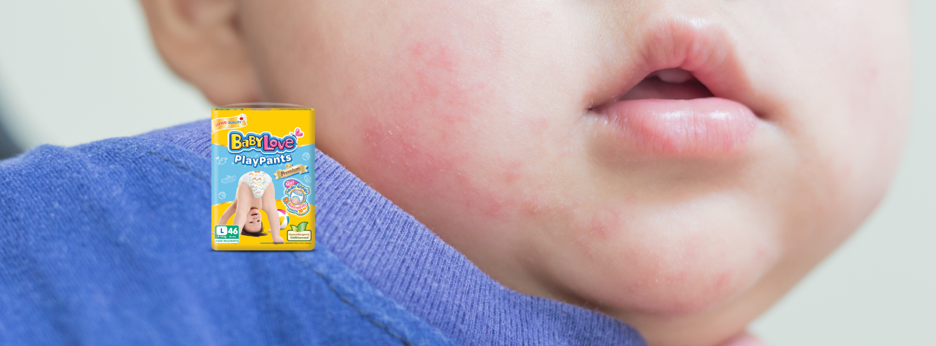 Baby Rash: Parents’ Trouble Everyday