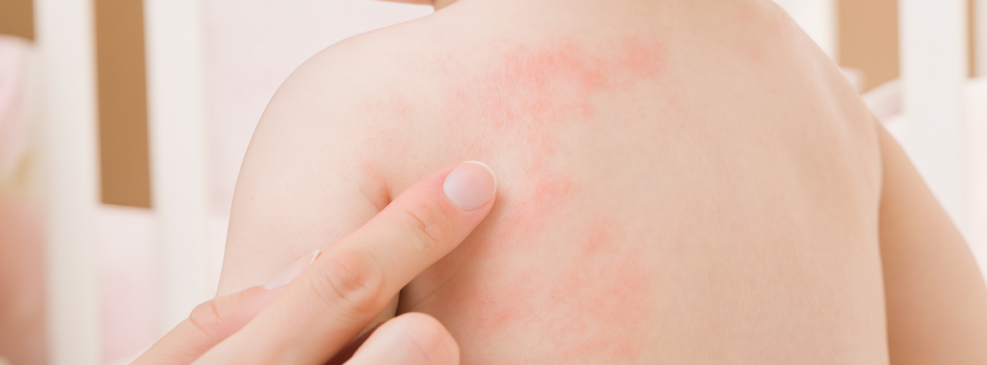 Dealing with 'Hives' in Children during Summer