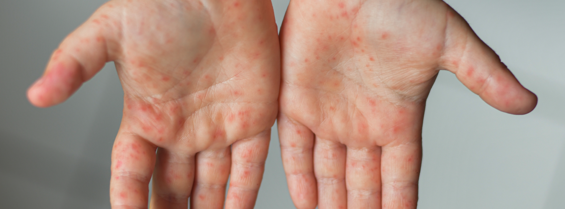 Children with high fever and red rashes should be watched carefully for risk of ‘scarlet fever’