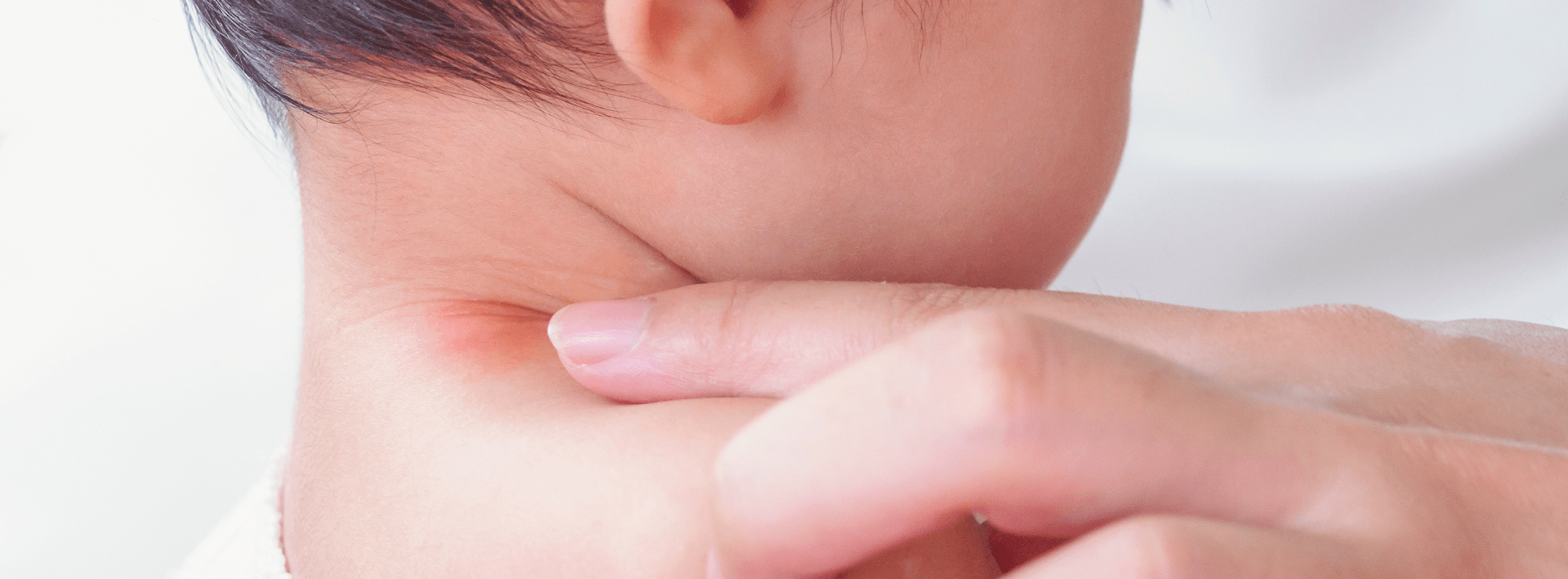 “Skin rash”: close danger that hurts baby's skin in hot and humid time