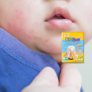 Baby Rash: Parents’ Trouble Everyday