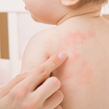 Dealing with 'Hives' in Children during Summer