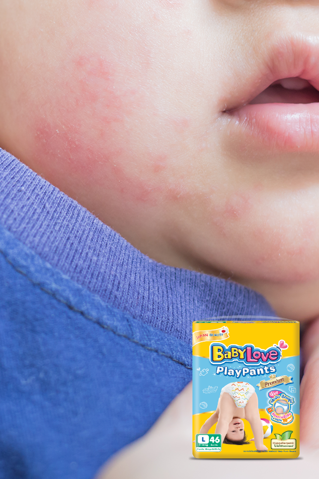 Baby Rash: Parents’ Trouble Everyday