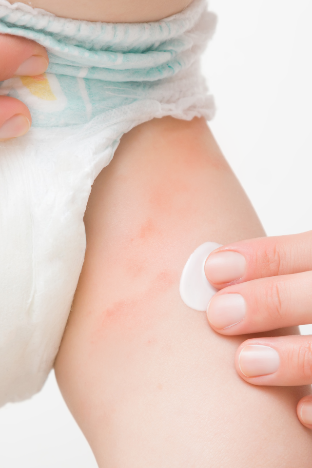 "How to Deal with 'Diaper Rash Fungus'? Doctor Has Answered!"