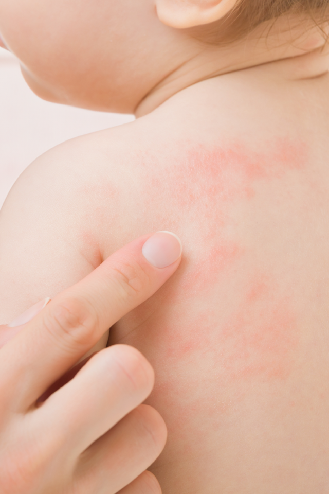 Dealing with 'Hives' in Children during Summer