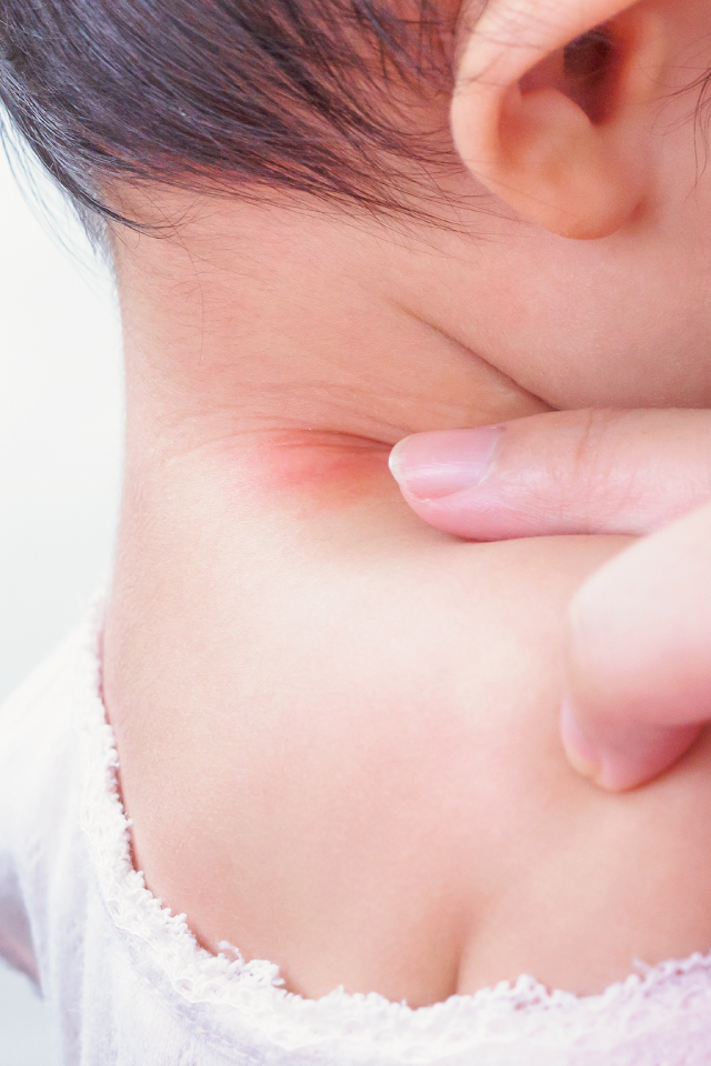 “Skin rash”: close danger that hurts baby's skin in hot and humid time