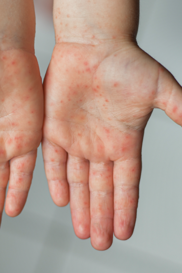 Children with high fever and red rashes should be watched carefully for risk of ‘scarlet fever’