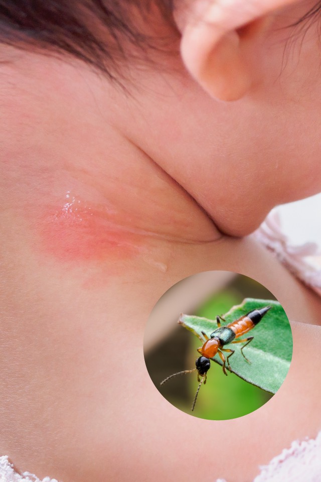 Rove Beetle: Danger for Parents and Babies Alike