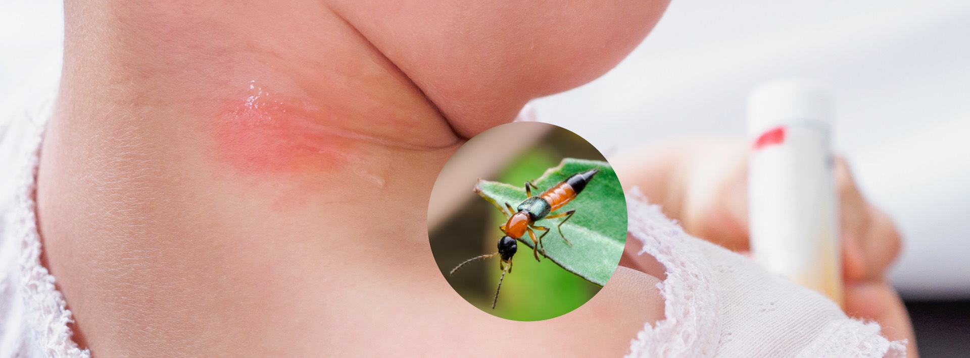 Rove Beetle: Danger for Parents and Babies Alike
