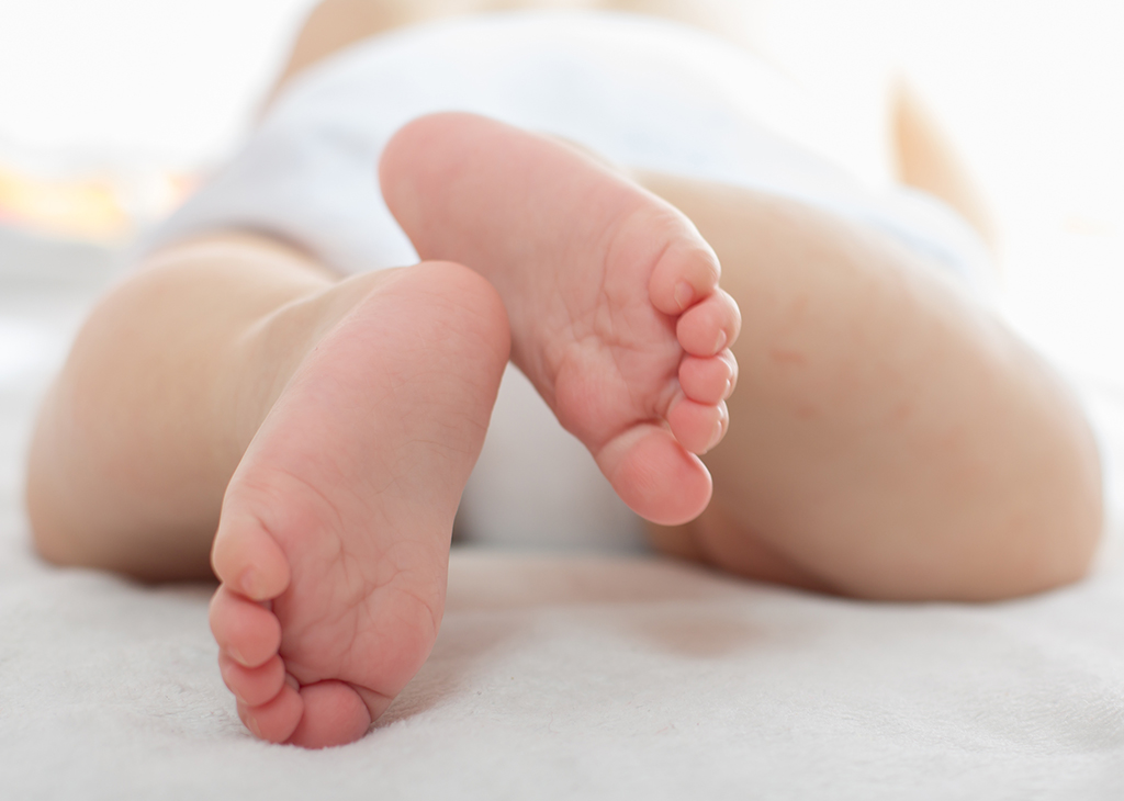 Is it true that disposable diapers cause physiologic bow legs?